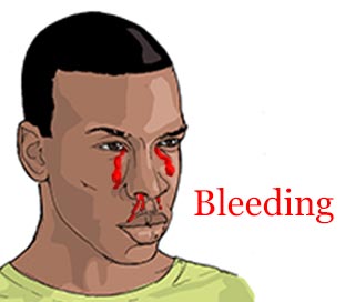 Ebola main symptoms, signs - bleeding 