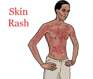 Ebola main symptoms, signs - rash