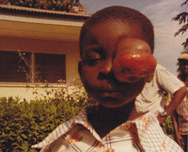The girl with Rhabdomayosarcoma cancer, and getting her ready for surgery